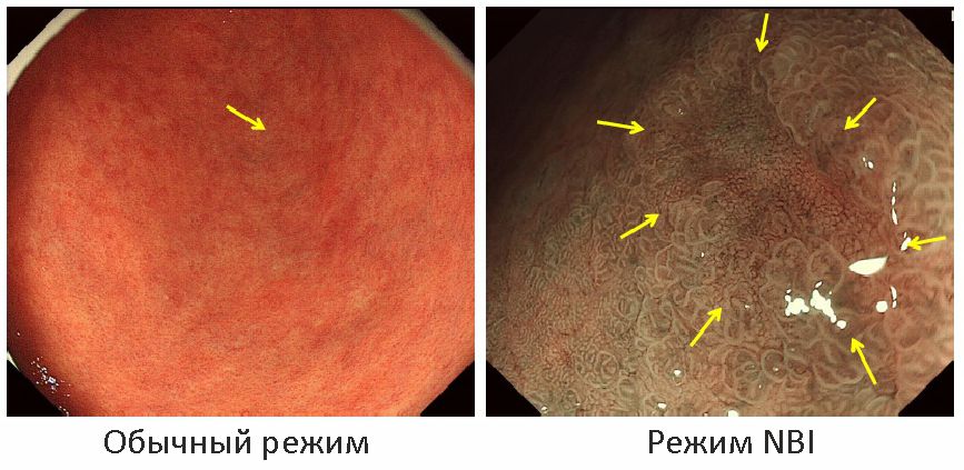 гастроскопия режим NBI